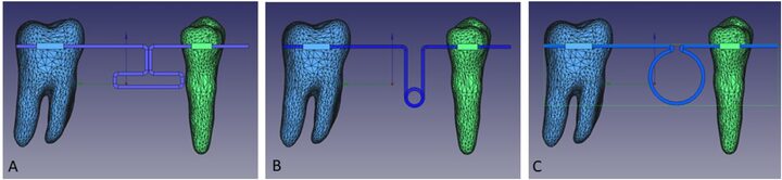Figure 1, Mehta et al., Scientific Reports (2025), CC BY-NC-ND 4.0 Finite-element models of the molar with the T loop, Cherry loop and open helical loop.