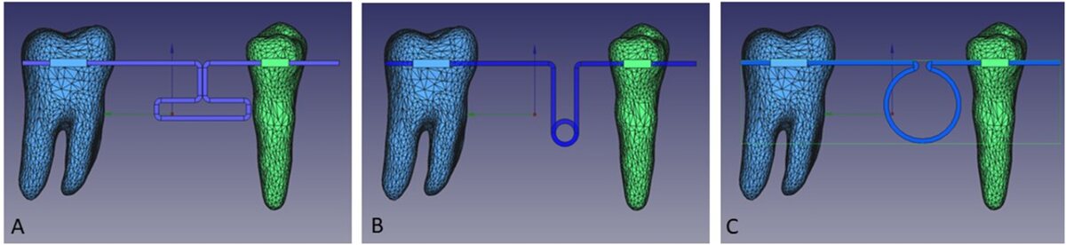 Figure 1, Mehta et al., Scientific Reports (2025), CC BY-NC-ND 4.0 Finite-element models of a mandibular molar with T, Cherry and open helical protraction loops.